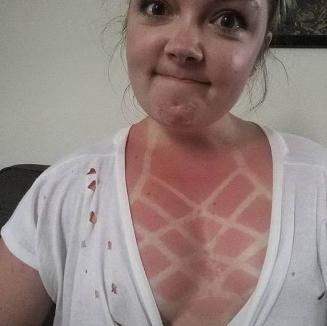 девушка обгорела на солнце