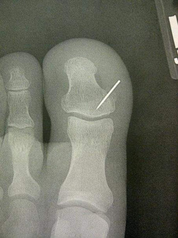 рентген пальца с иголкой